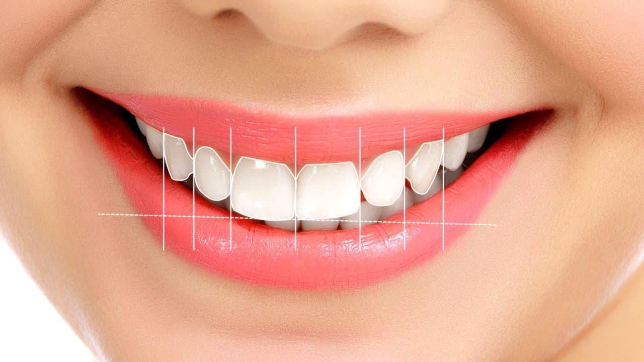 What is Smile Design? How is it done?