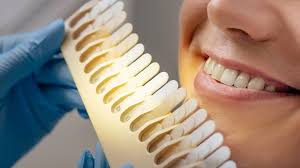 Diş Kaplamaları (Veneer)